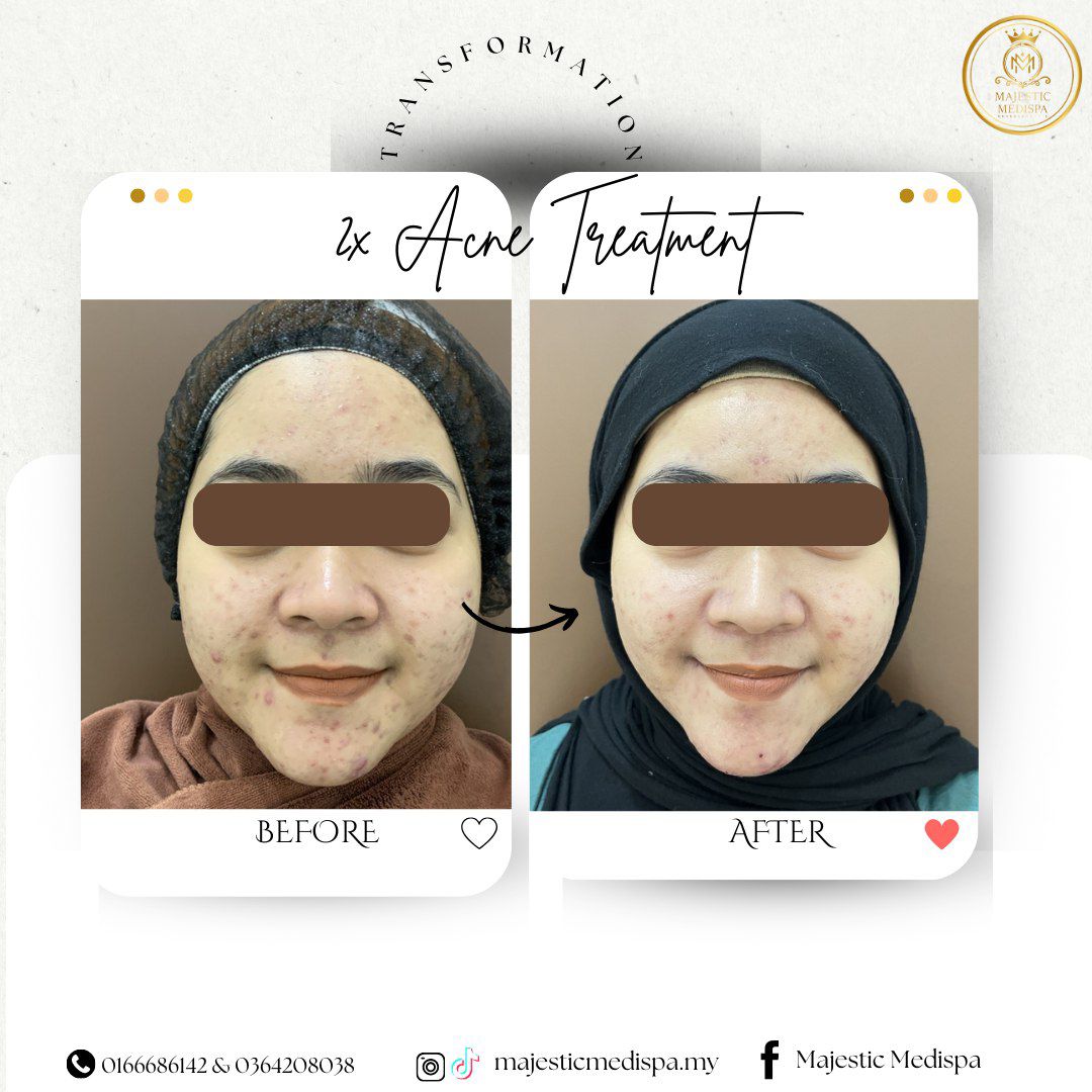 Consented acne treatment before and after proof asset
