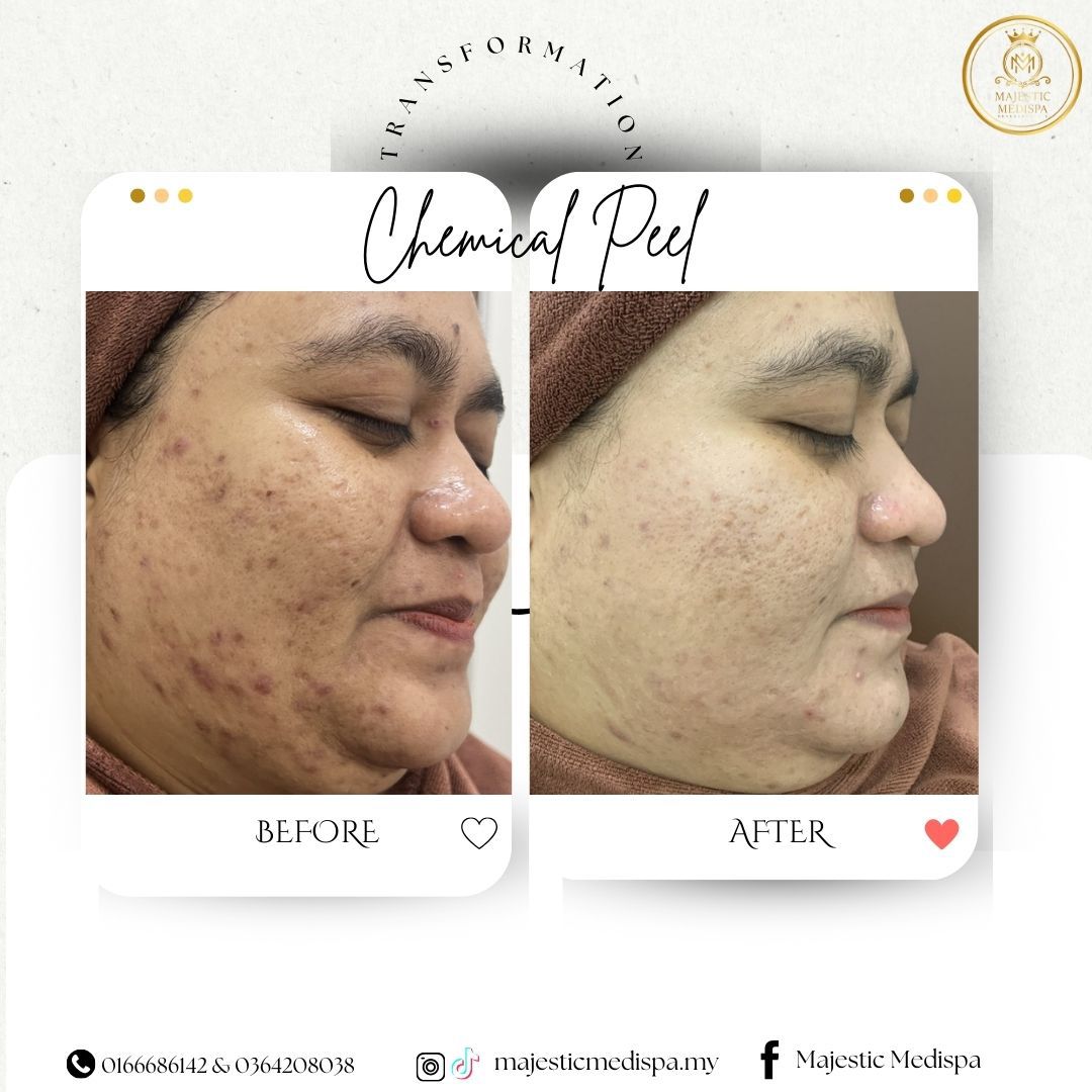 Consented chemical peel before and after proof asset