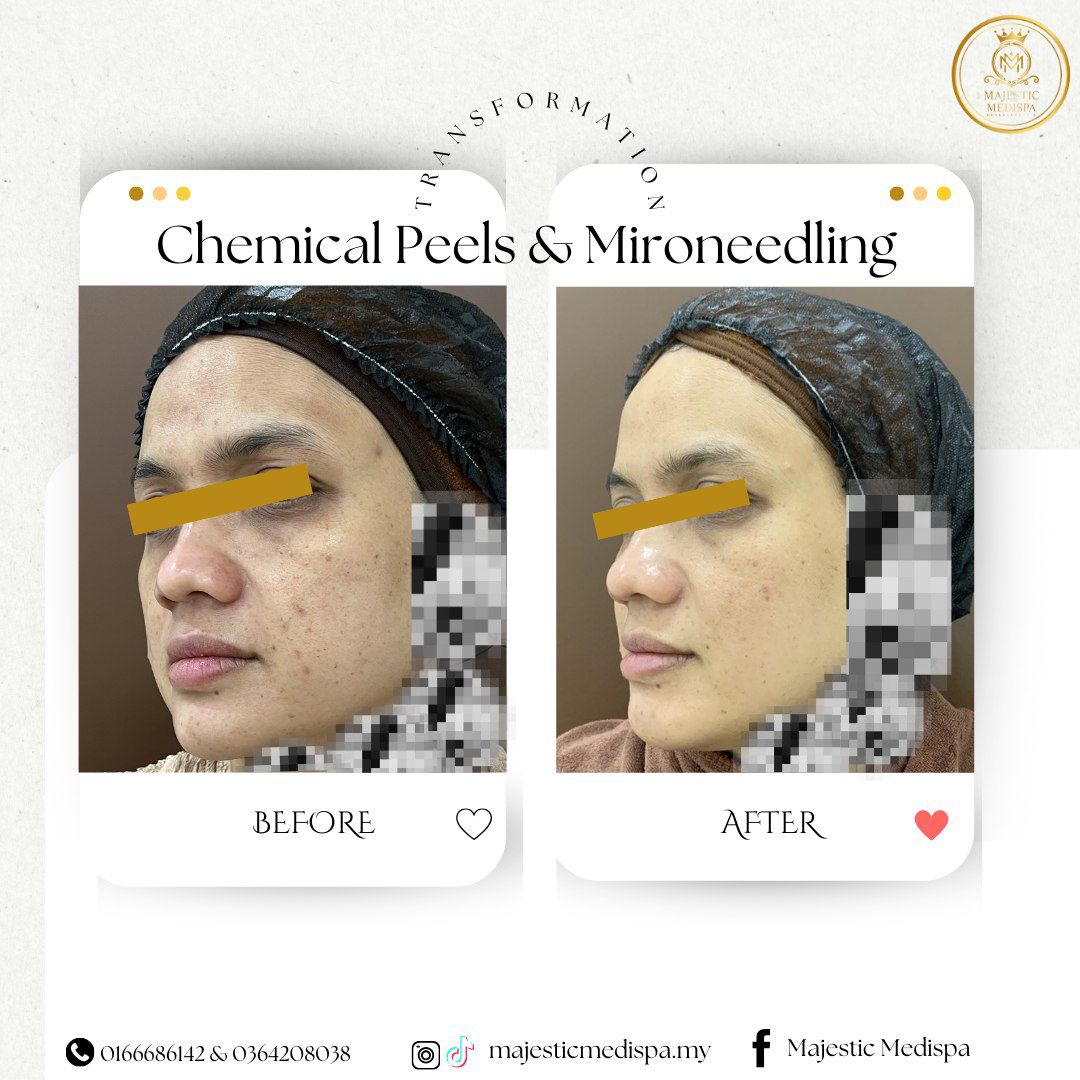 Consented chemical peel and microneedling before and after proof asset