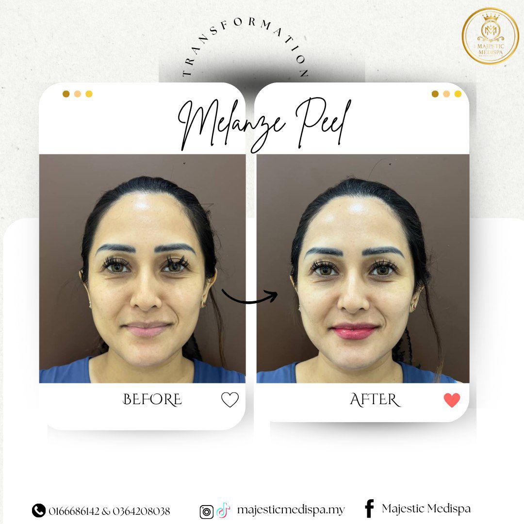 Consented melasma-like pigmentation before and after proof asset