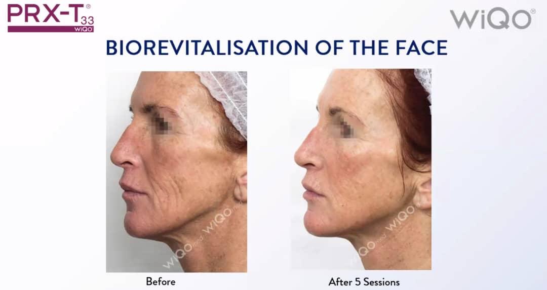 Majestic-supplied PRX biorevitalisation face before and after visual