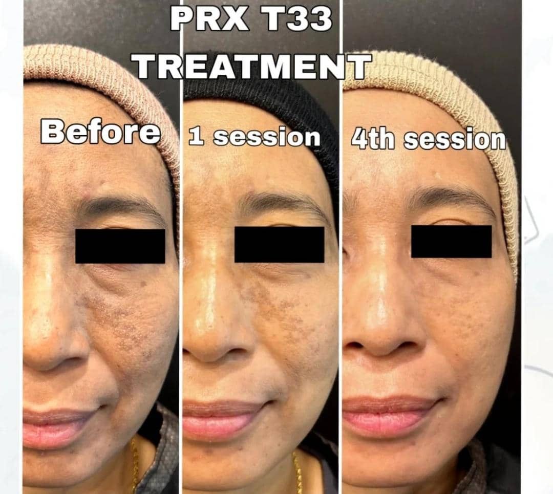 Majestic-supplied PRX-T33 treatment progress visual