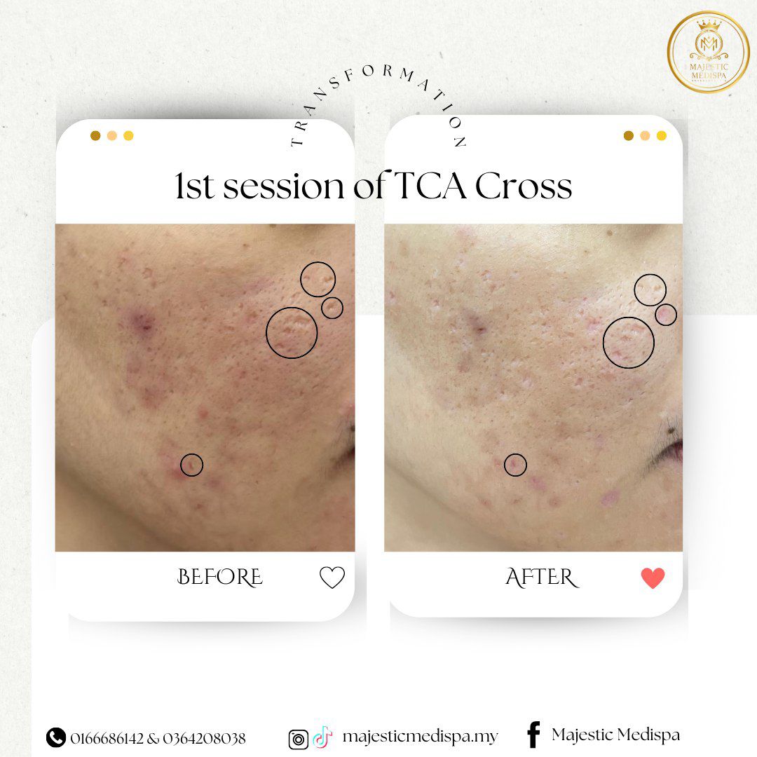 Consented TCA cross before and after proof asset